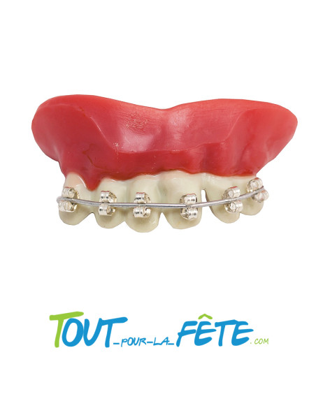Dentier avec appareil dentaire fournis avec pâte thermo-plastique